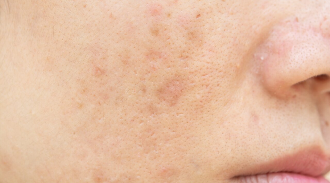 What Are Dark Spots?