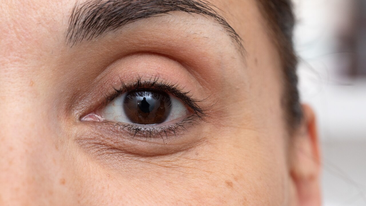 What Causes Dark Circles Under Eyes? (Expert-Backed Breakdown)