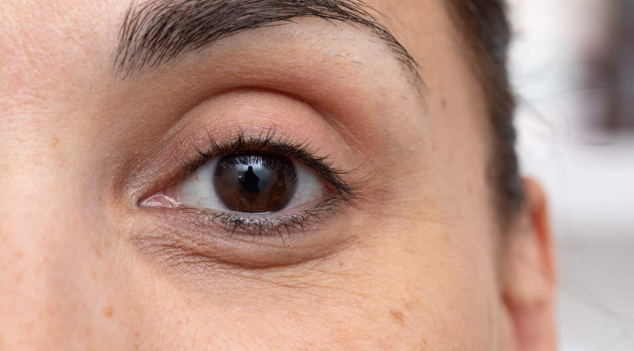 What Causes Dark Circles Under Eyes? (Expert-Backed Breakdown)