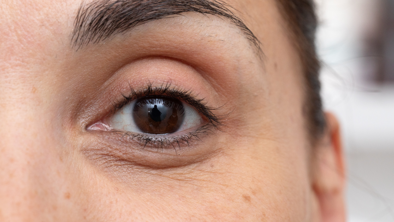 What Causes Dark Circles Under Eyes? (Expert-Backed Breakdown)