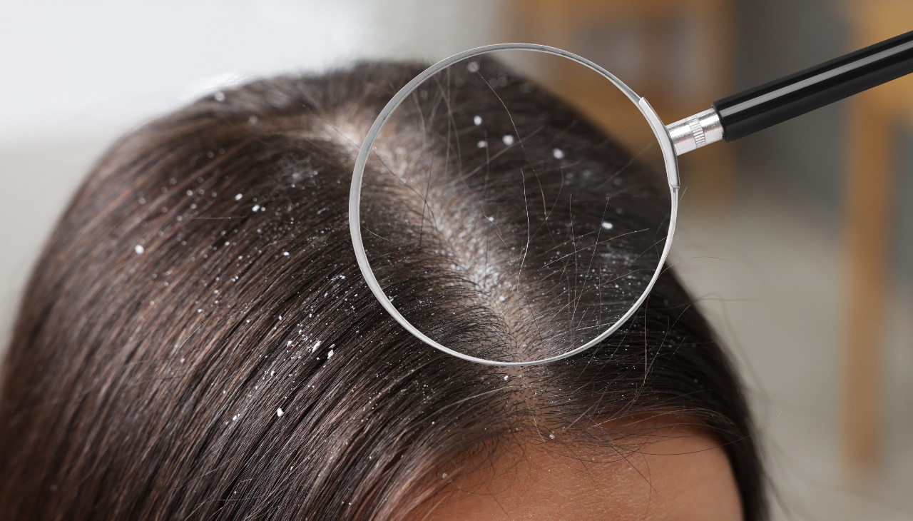 Fights Scalp Fungal Infections and Dandruff-