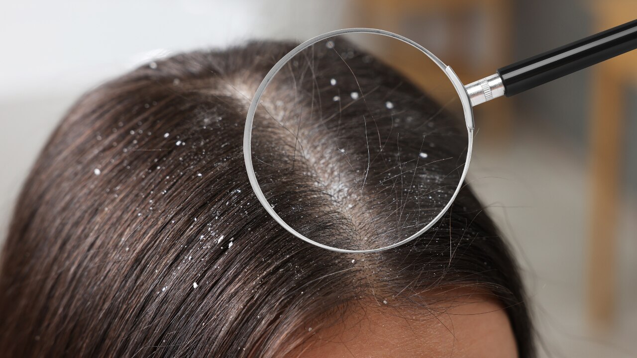 Fights Scalp Fungal Infections and Dandruff-