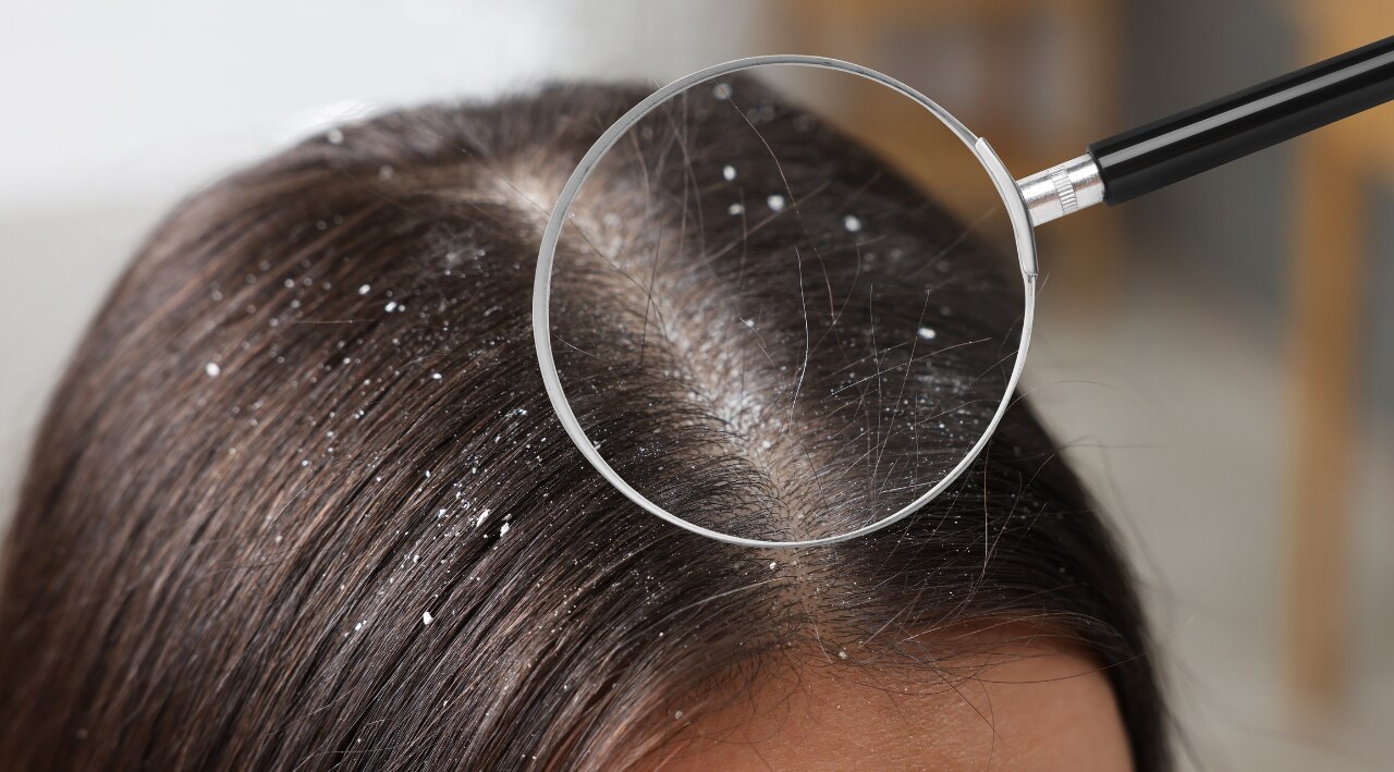 Fights Scalp Fungal Infections and Dandruff-