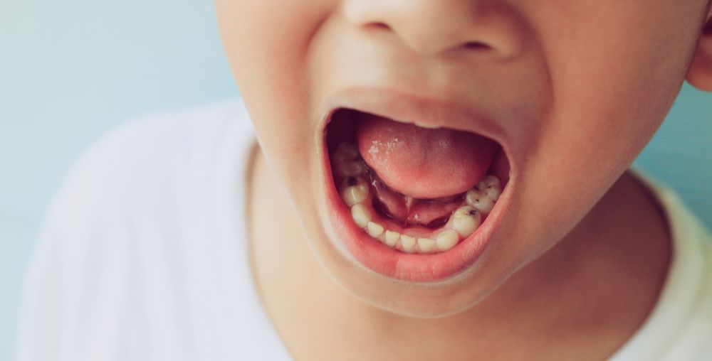 penularan gigi berlubang pada anak