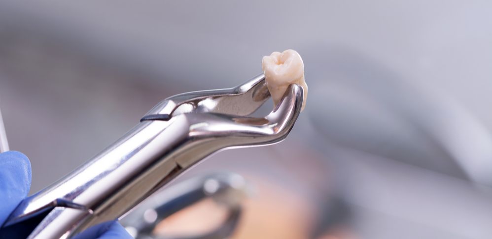 bolehkah sikat gigi setelah cabut gigi