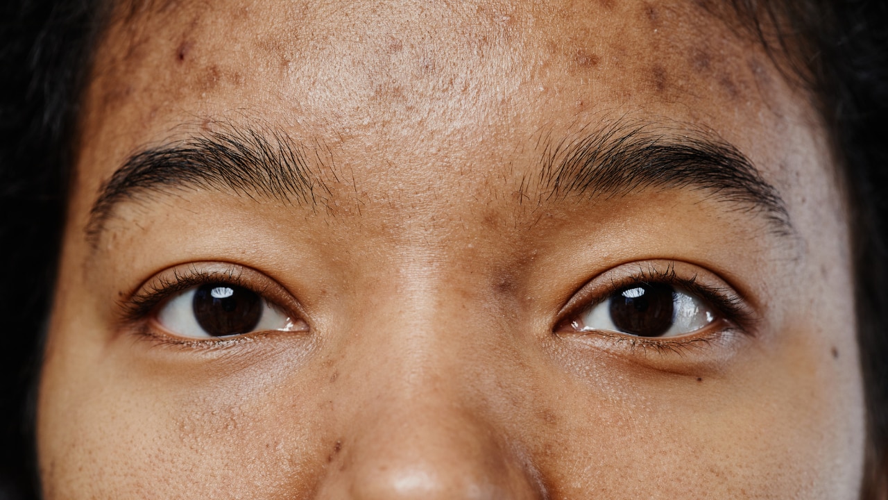 Common Causes of Pigmentation