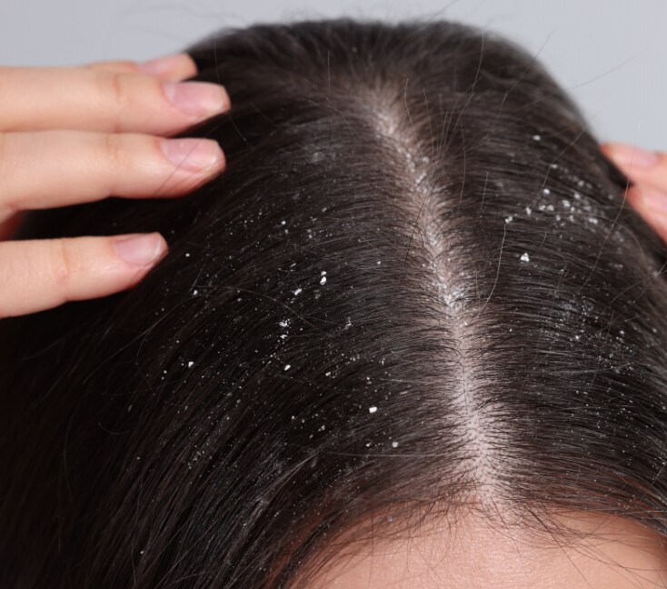 Image of Dandruff Treatment at Home: Home Remedies to Get Rid of Winter Dandruff