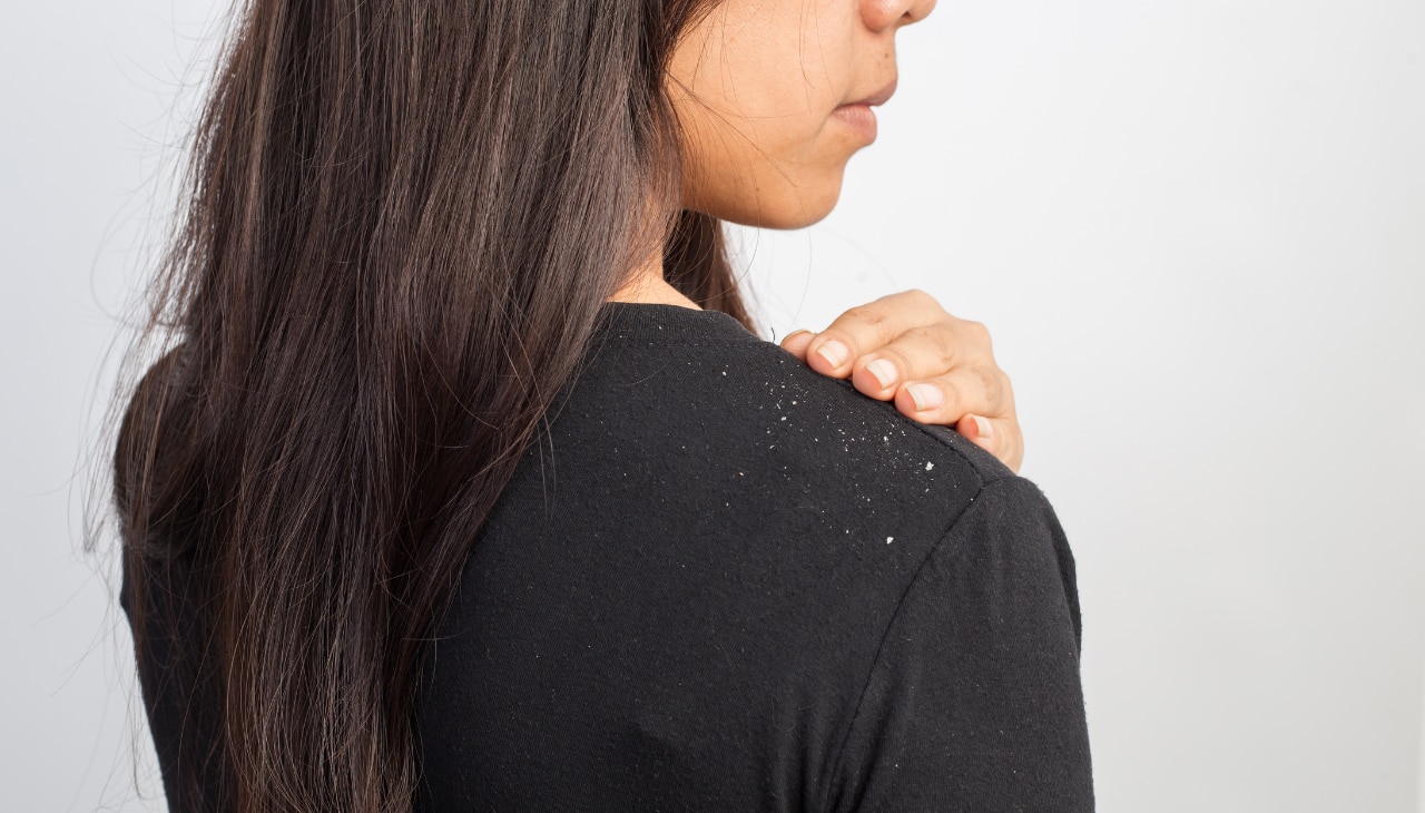How to Get Rid of Dandruff: The Holistic Approach
