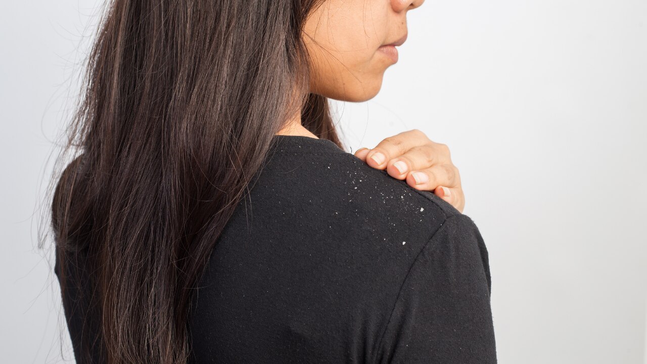 How to Get Rid of Dandruff: The Holistic Approach