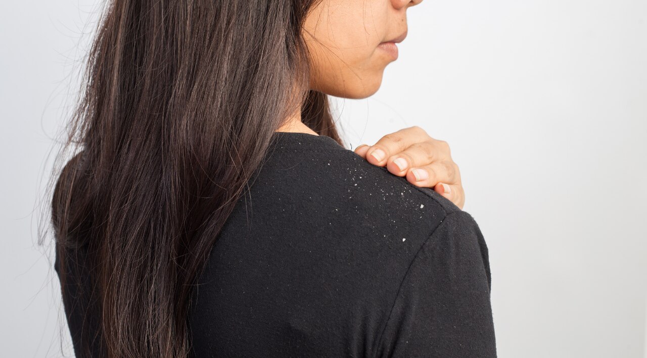 How to Get Rid of Dandruff: The Holistic Approach