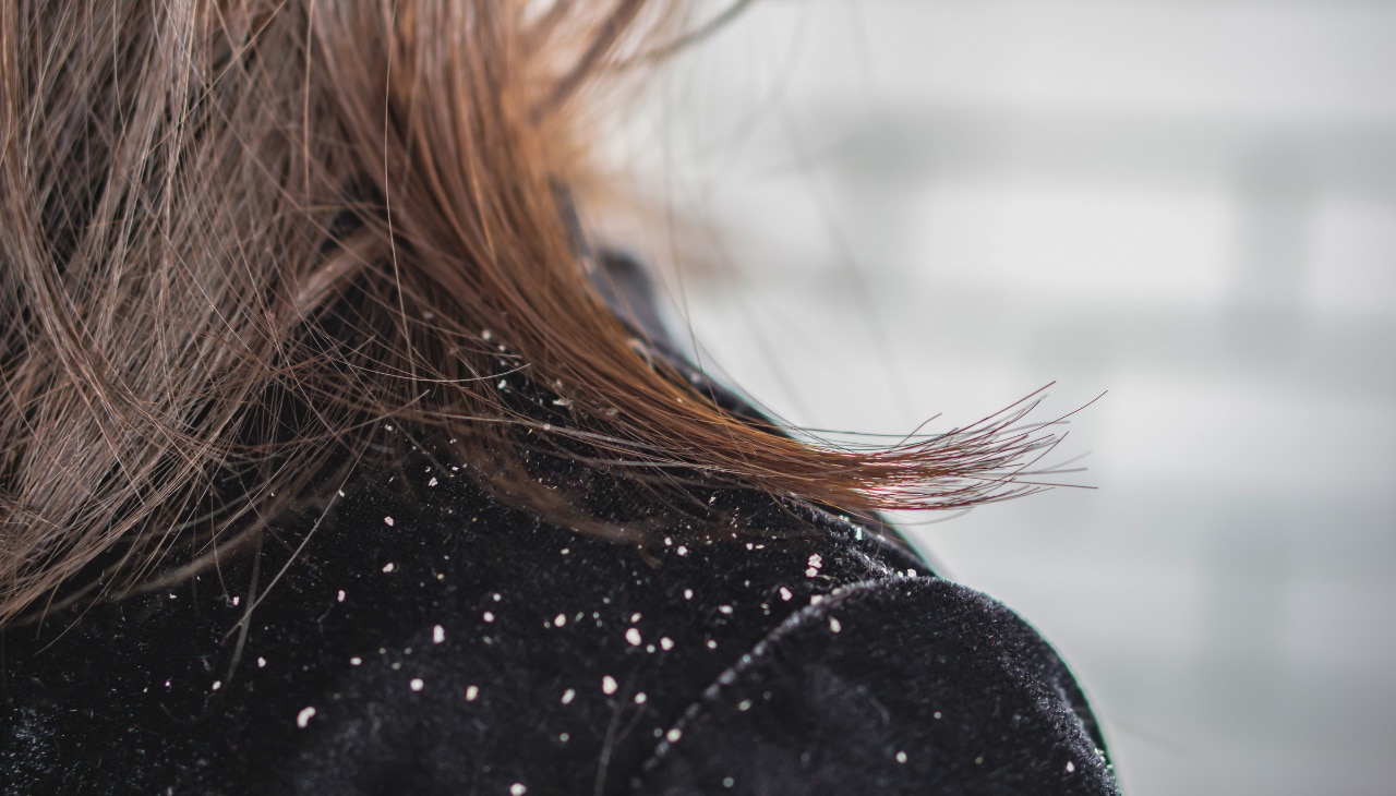 What Causes Dandruff and Why Winter is the Catalyst?