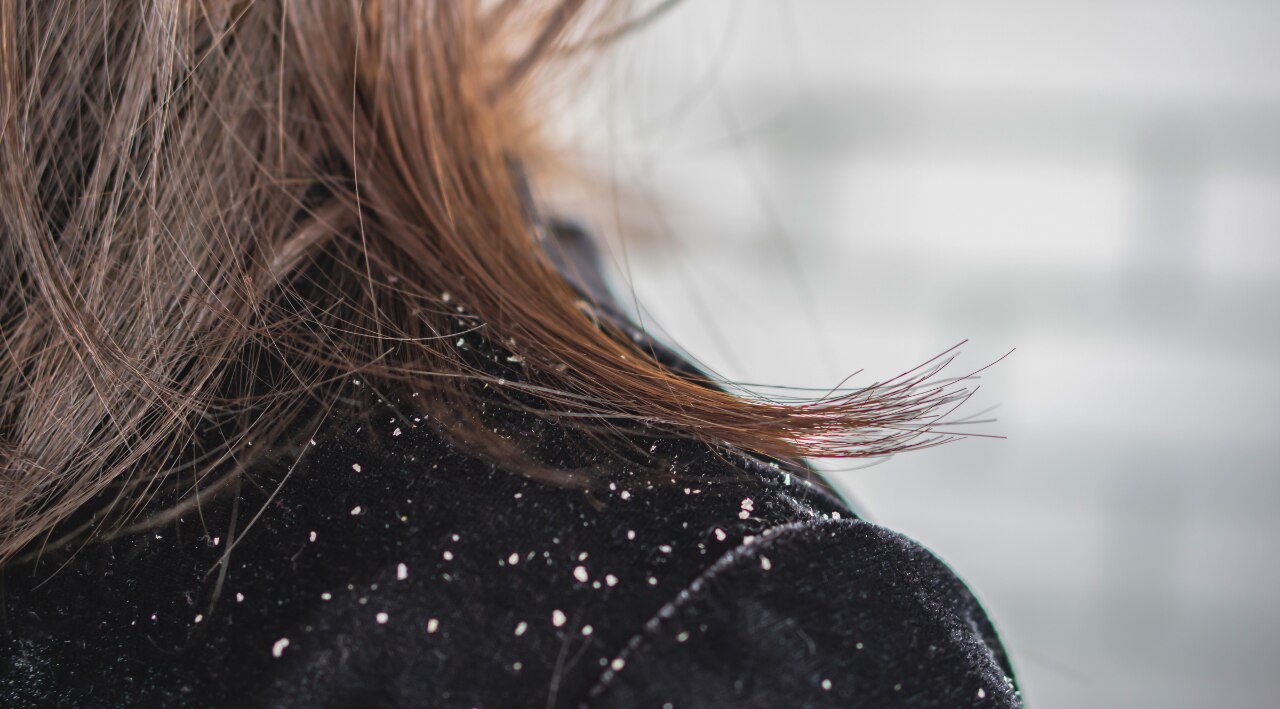 What Causes Dandruff and Why Winter is the Catalyst?