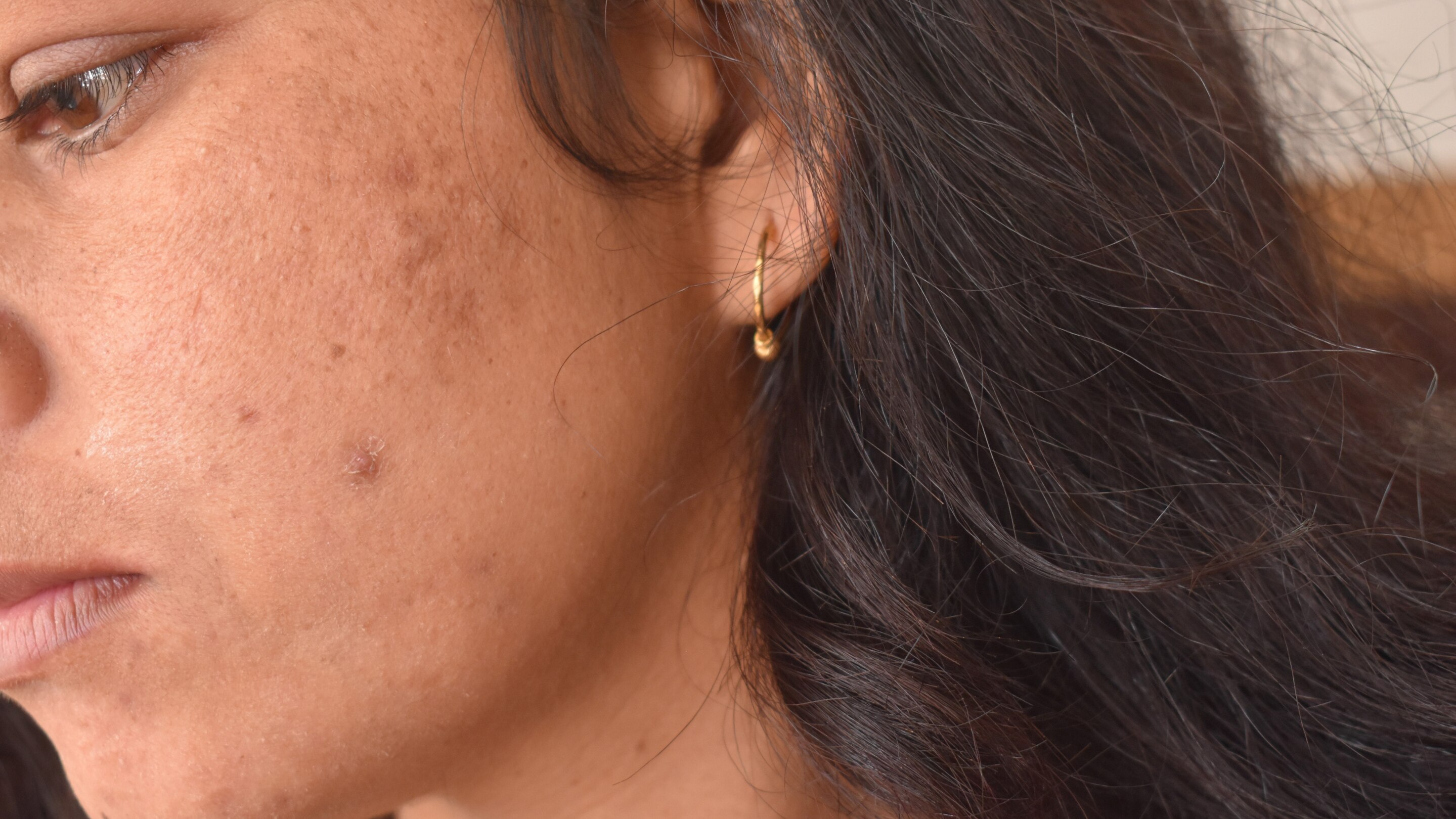 Causes of PCOS Acne