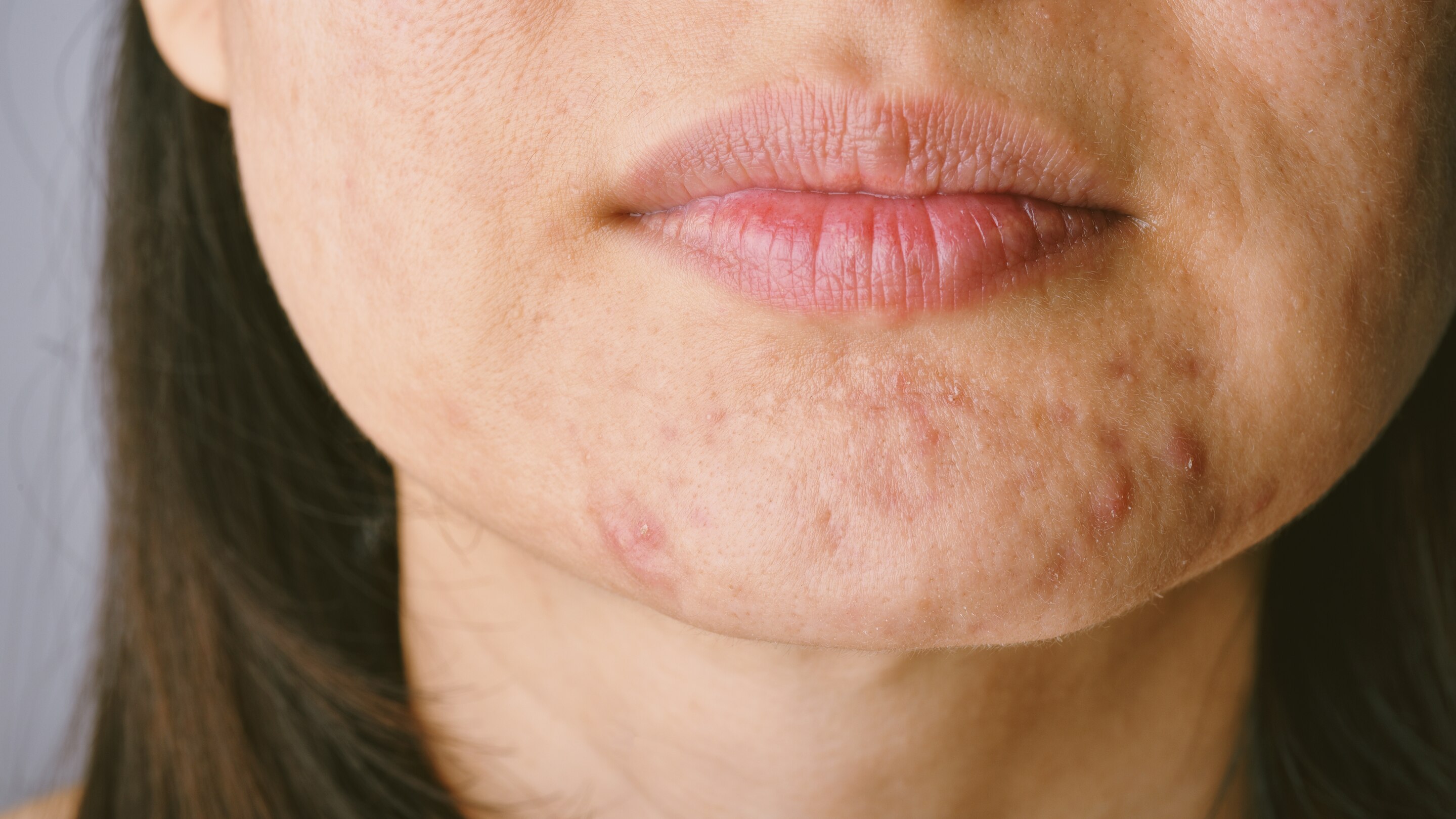 Common Mistakes to Avoid in Your PCOS Acne Treatment Journey