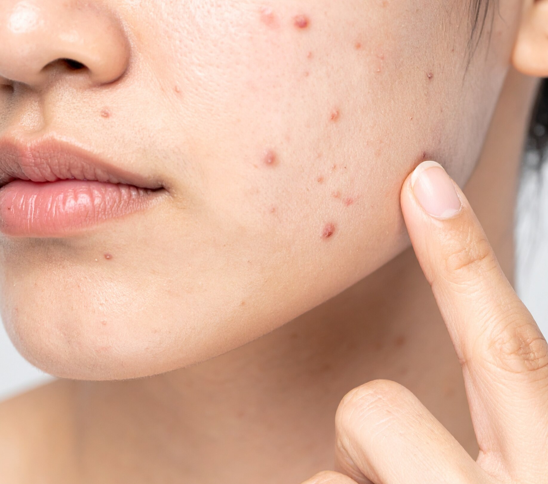Image of Say Goodbye to PCOS Acne with These Effective Home Remedies