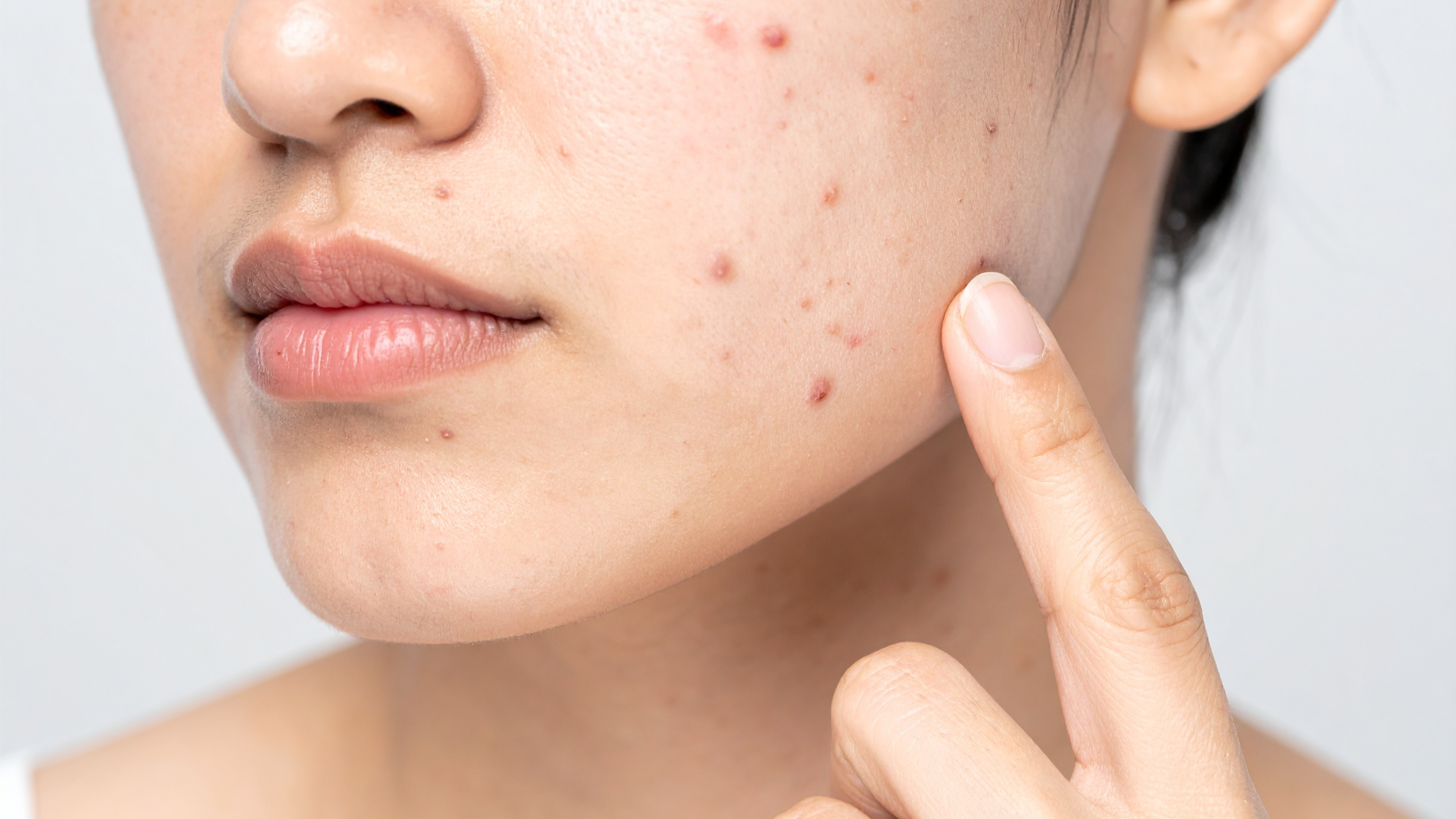 Effective Home Remedies for PCOS Acne and Hormonal Breakouts