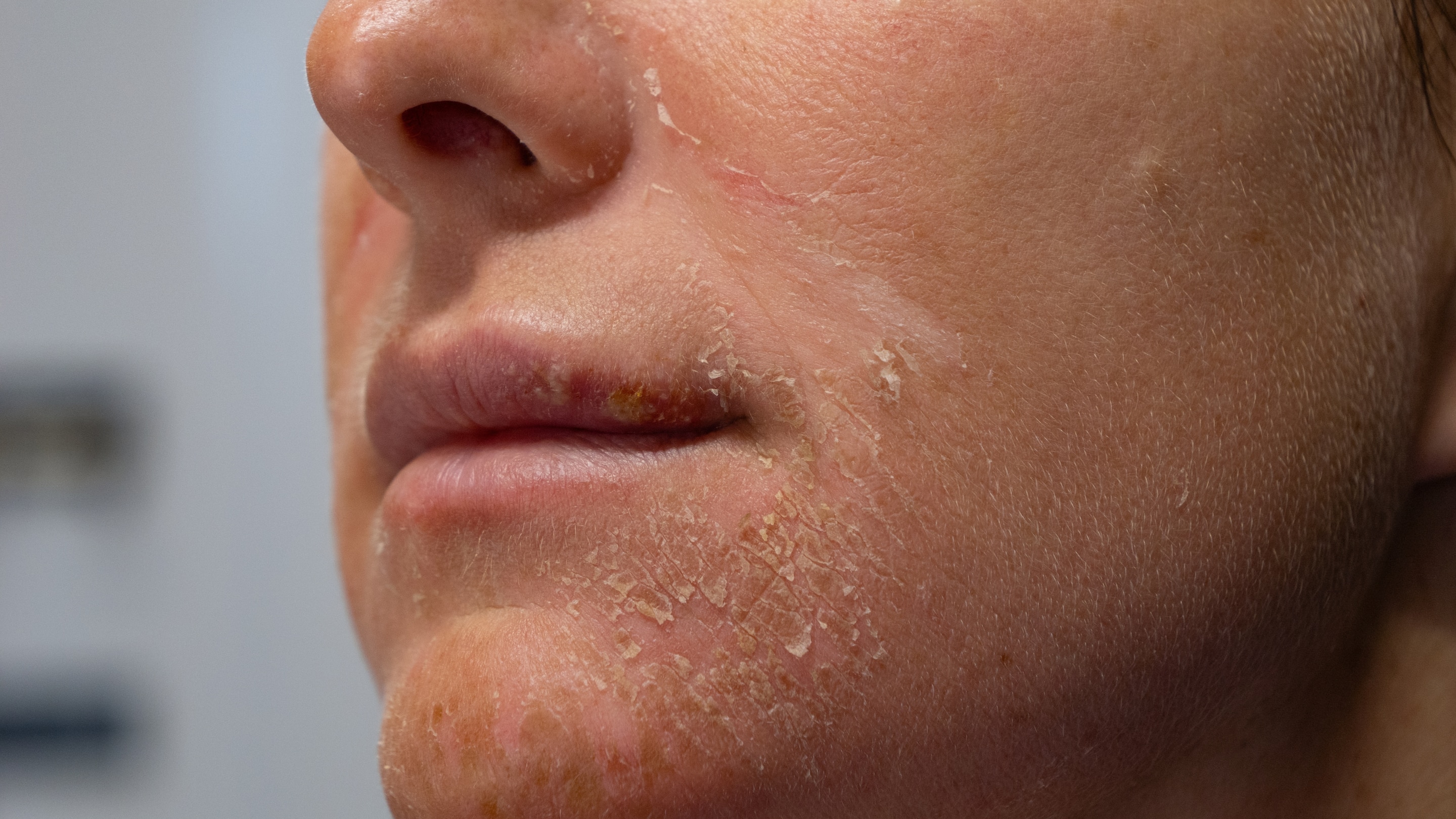 What Causes Sudden Dry Skin on the Face Image