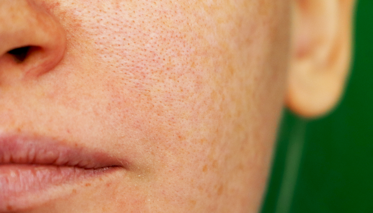 What Do Clogged Pores Look Like?