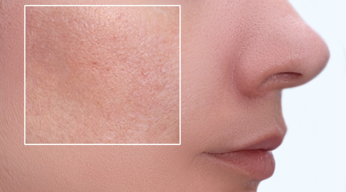 What Are Clogged Pores and How to Treat Them