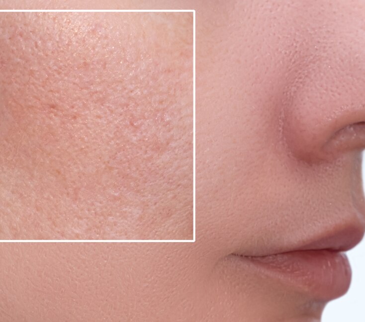 Image of Clogged Pores: What Are They and How to Get Rid Of Them