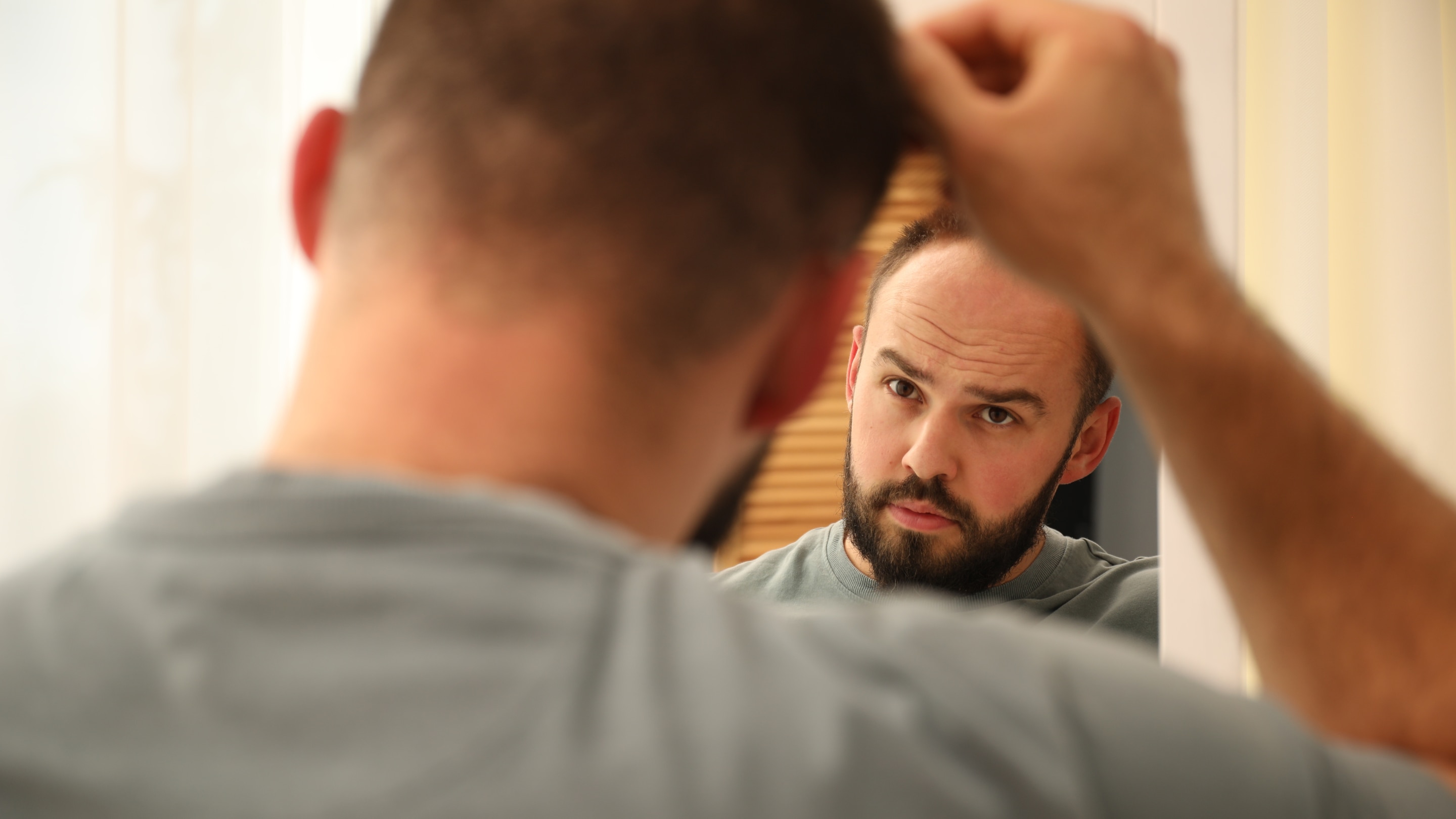 What Causes a Receding Hairline?