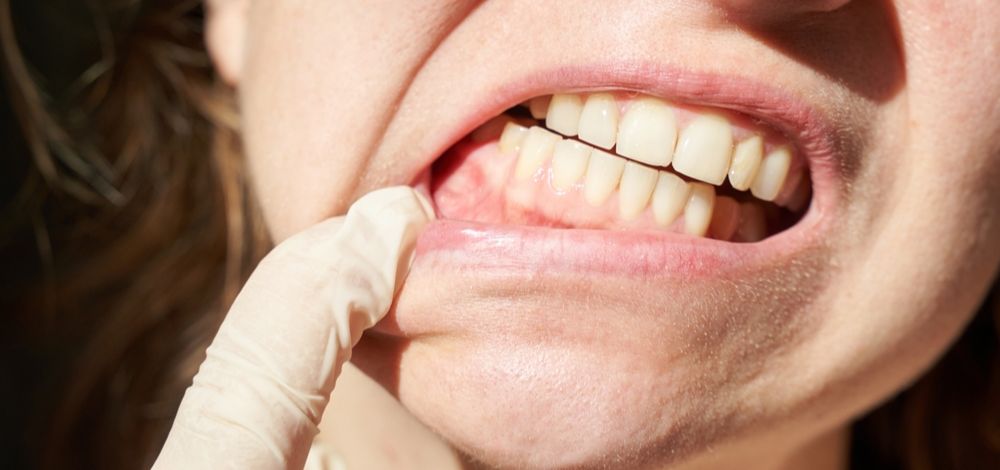 gusi bengkak warna putih