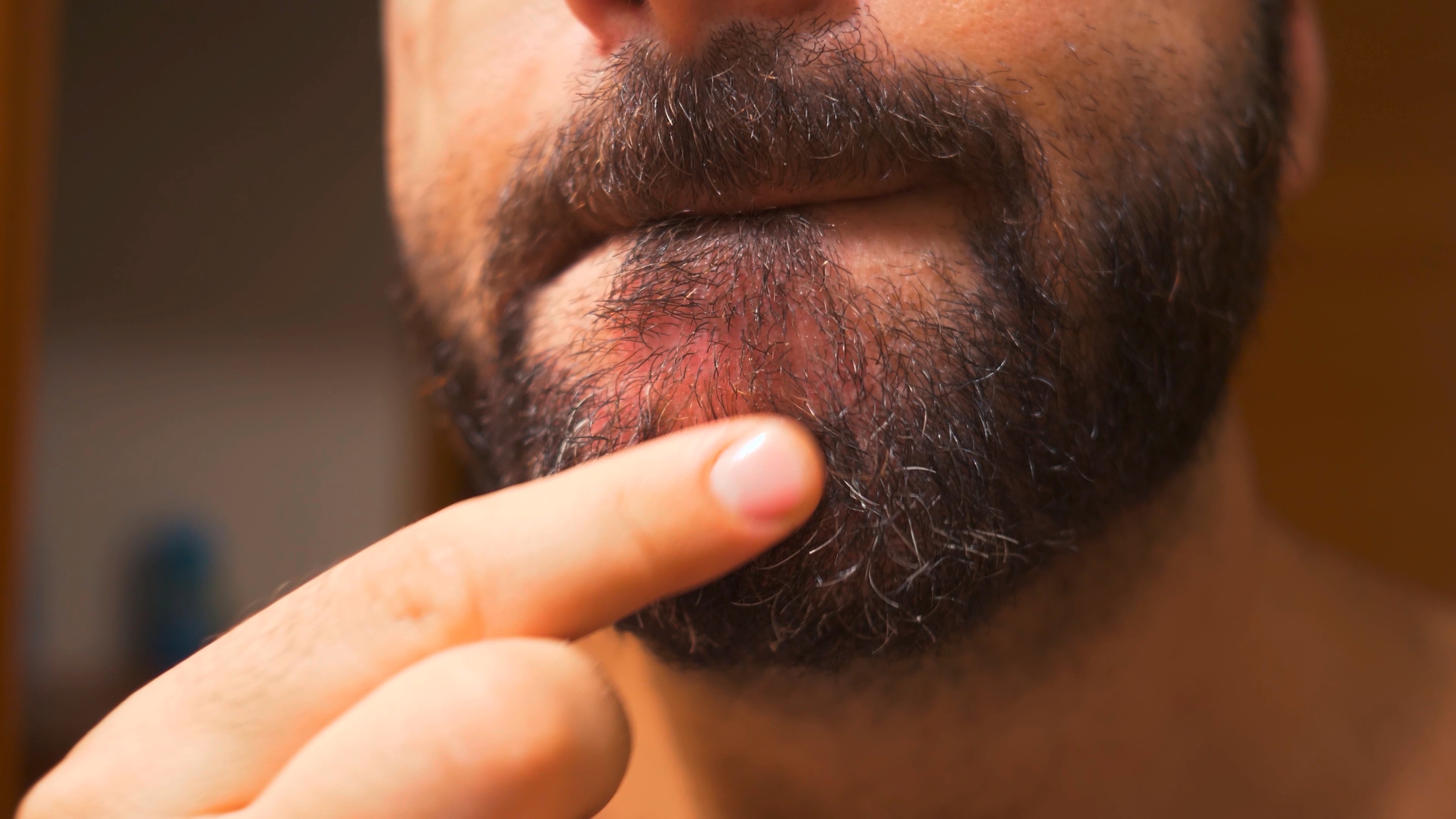 A man points to seborrheic dermatitis in his beard area.
