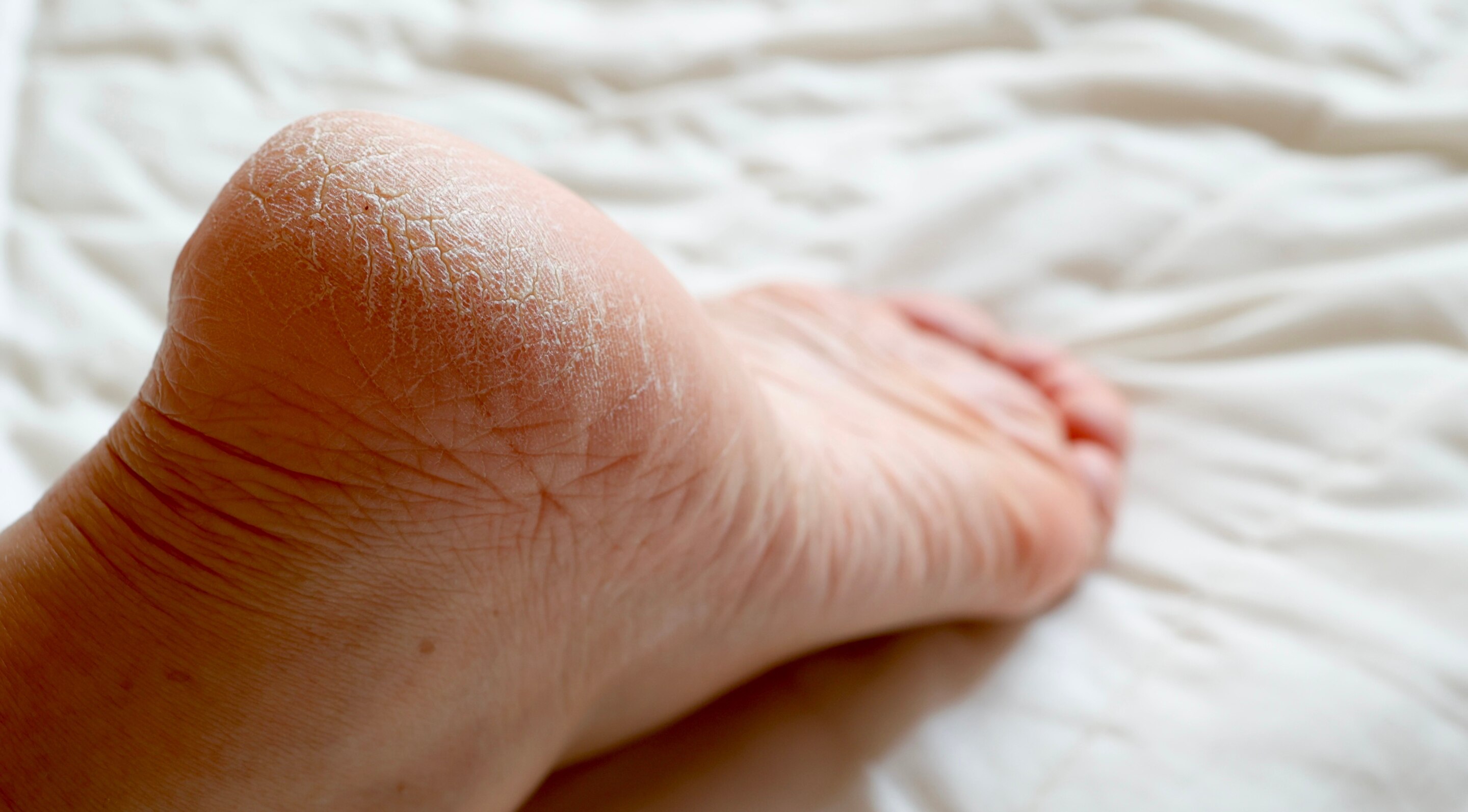 Why Heels Get Cracked
