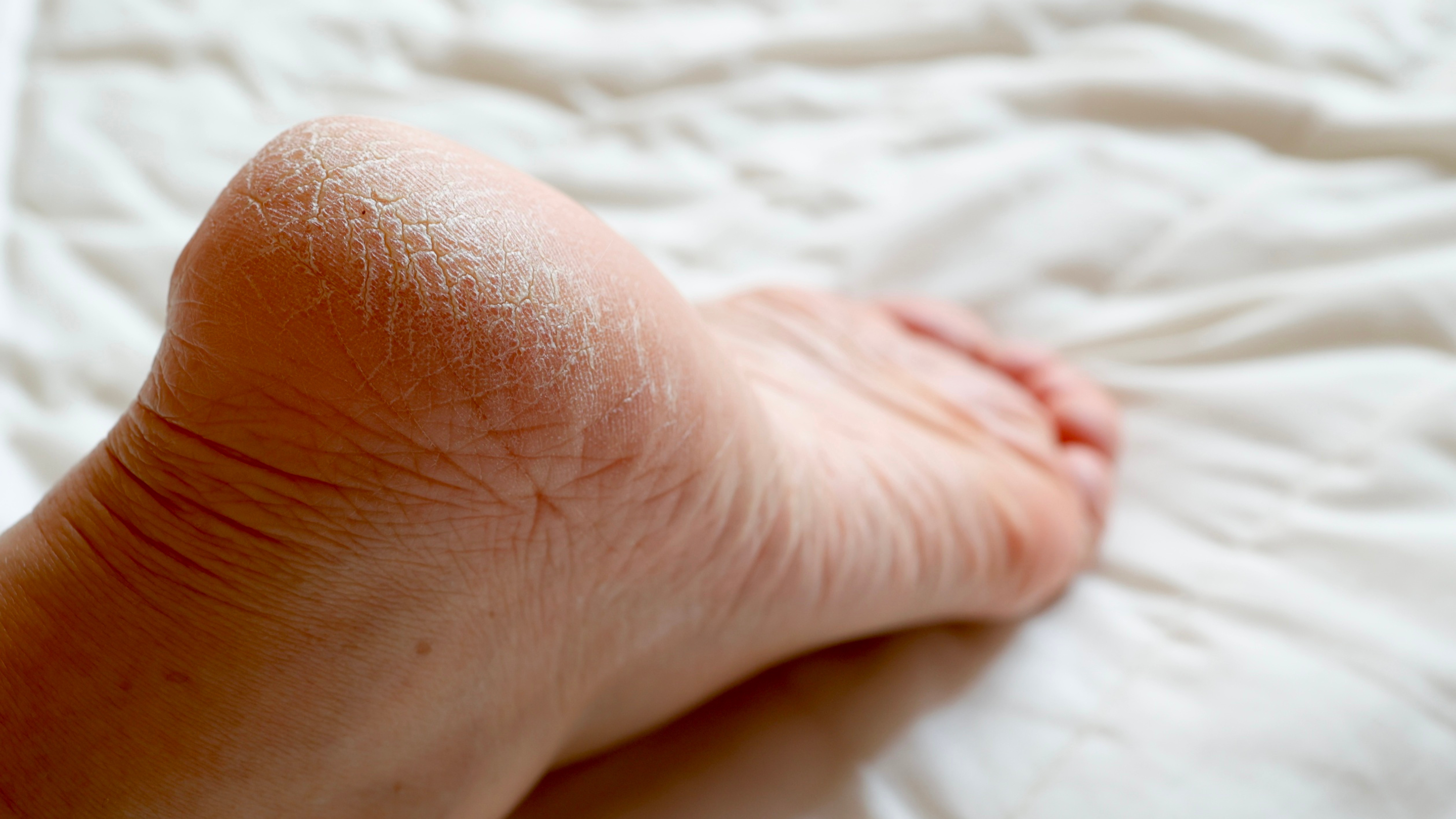 Why Heels Get Cracked