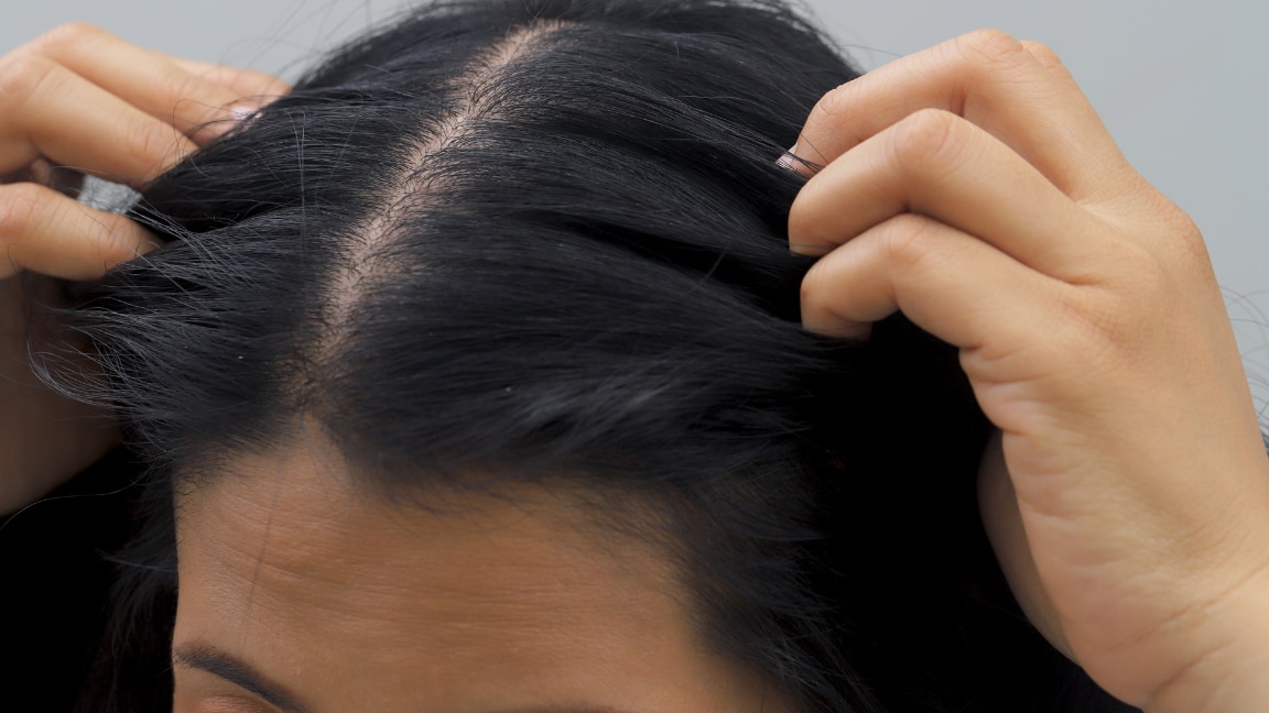 Image of Thinning Hair: Reasons, Causes, Treatments & Proven Remedies