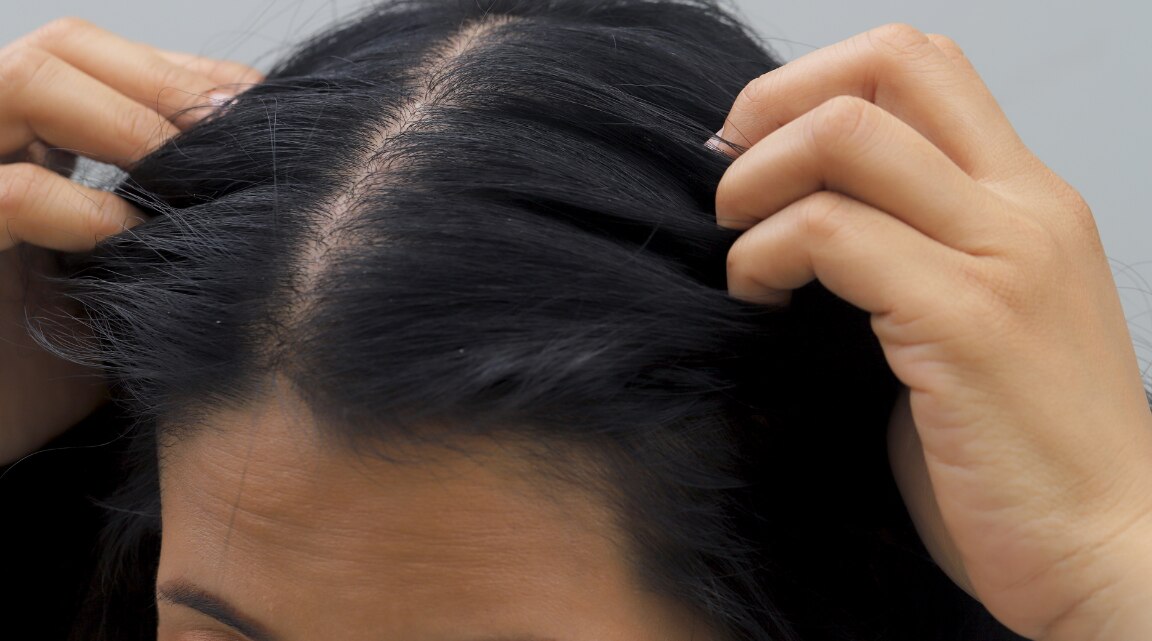 Thinning Hair Causes, Treatments and Remedies