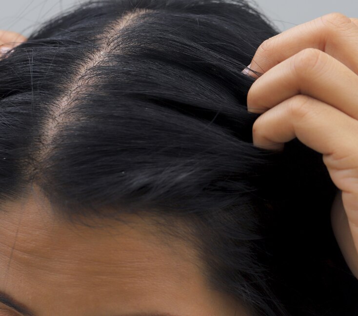 Image of Thinning Hair: Reasons, Causes, Treatments & Proven Remedies