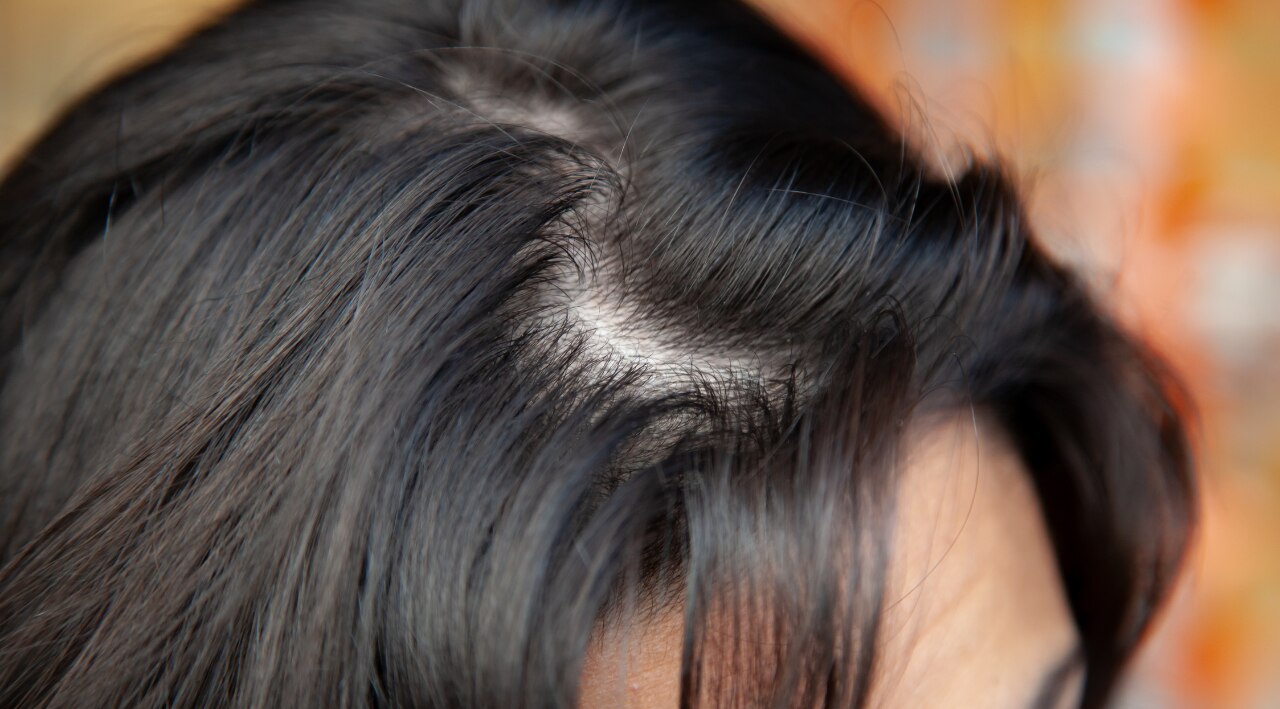 Signs and Symptoms of Thinning Hair