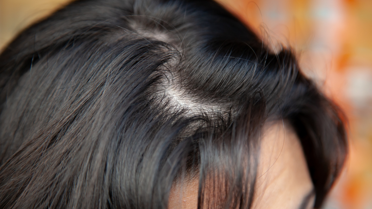 Signs and Symptoms of Thinning Hair