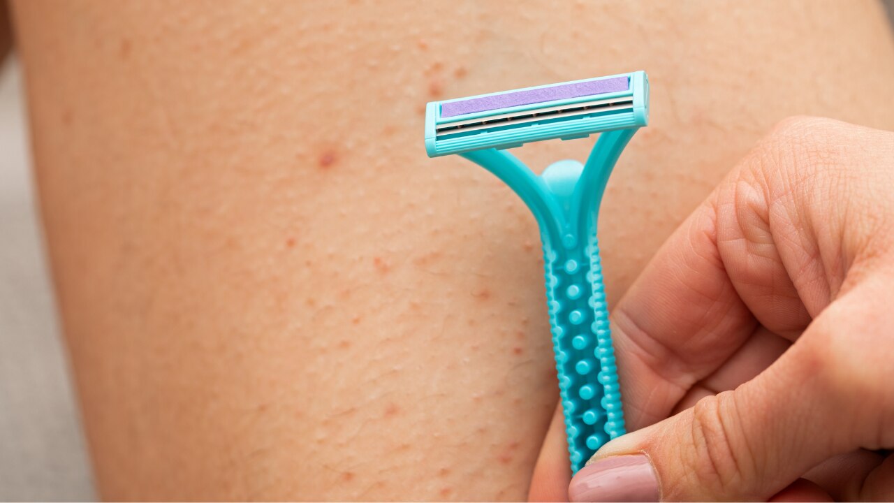 Folliculitis