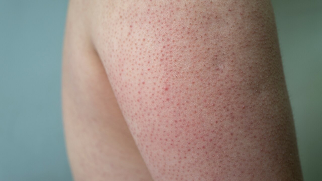 Keratosis Pilaris (KP)