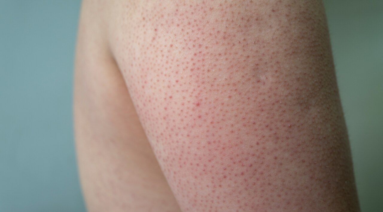Keratosis Pilaris (KP)