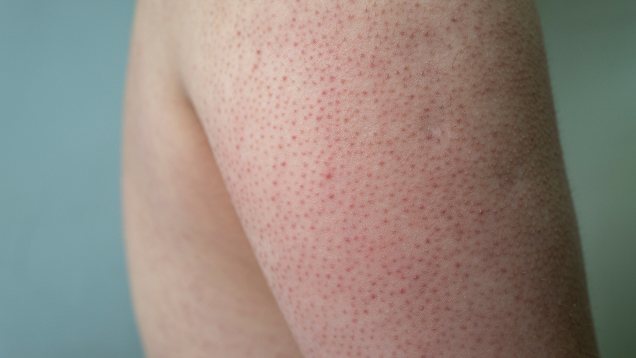 Keratosis Pilaris (KP)