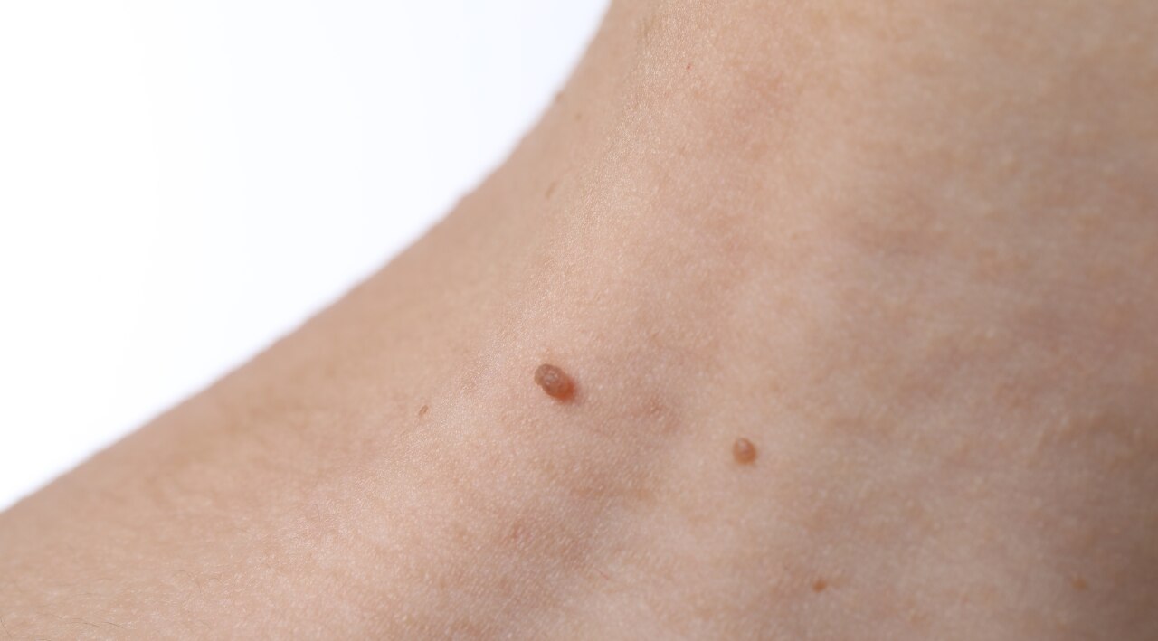 Skin Tags