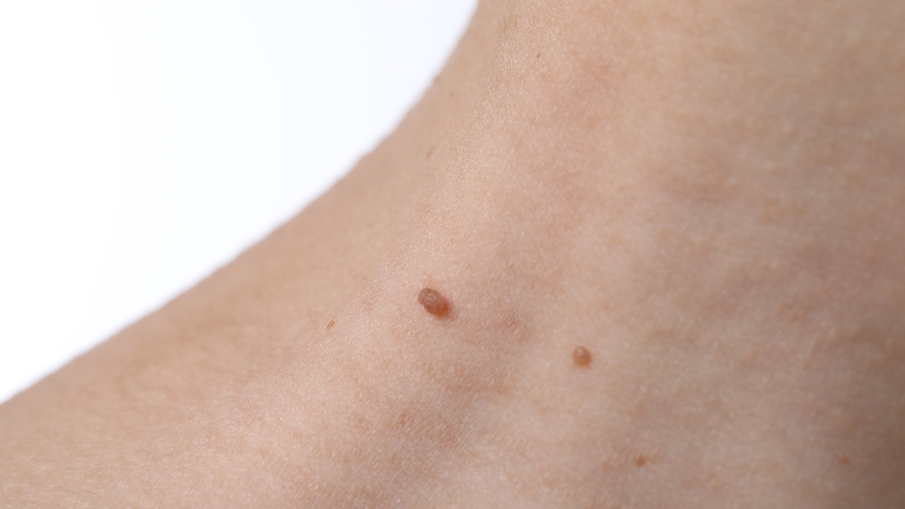 Skin Tags