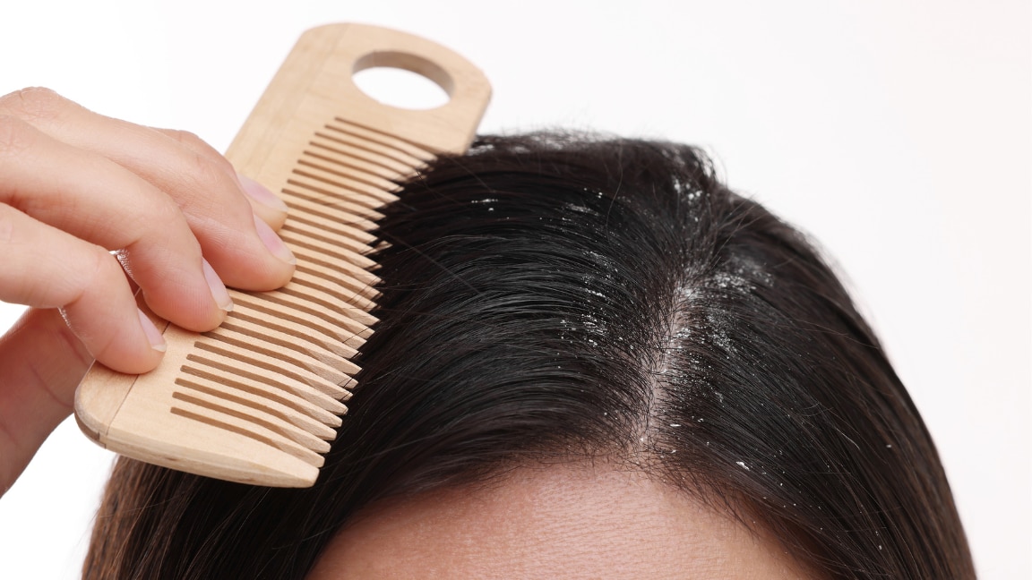 linking article: Does Dandruff Cause Hair Loss? Causes, Treatment & How to Stop It