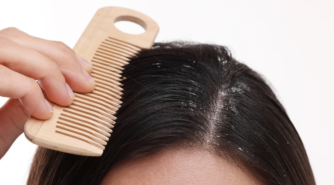 Does Dandruff Cause Hair Loss and How to Stop It