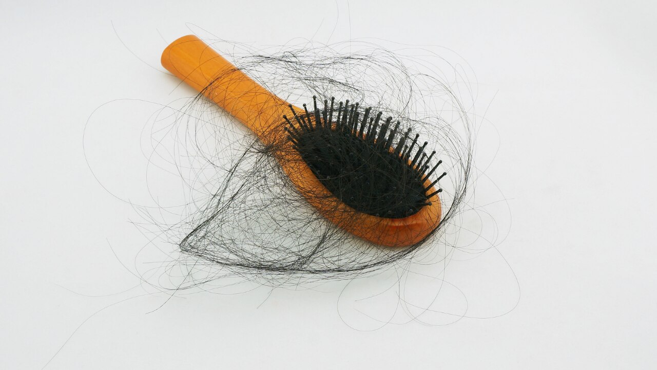 How to Prevent Hair Loss Due to Dandruff