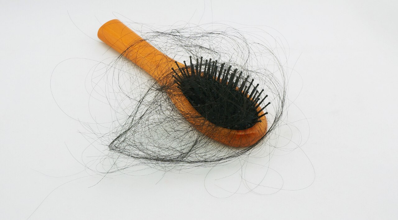 How to Prevent Hair Loss Due to Dandruff
