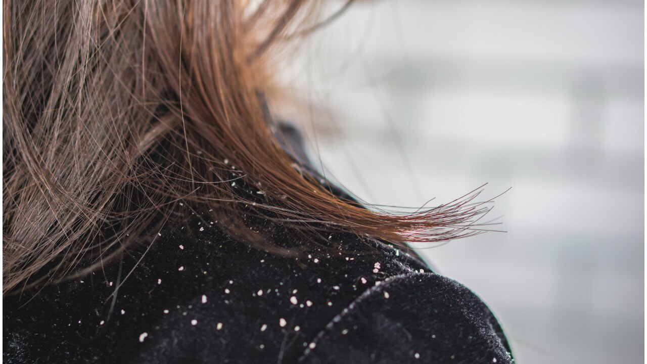 What Is Dandruff?