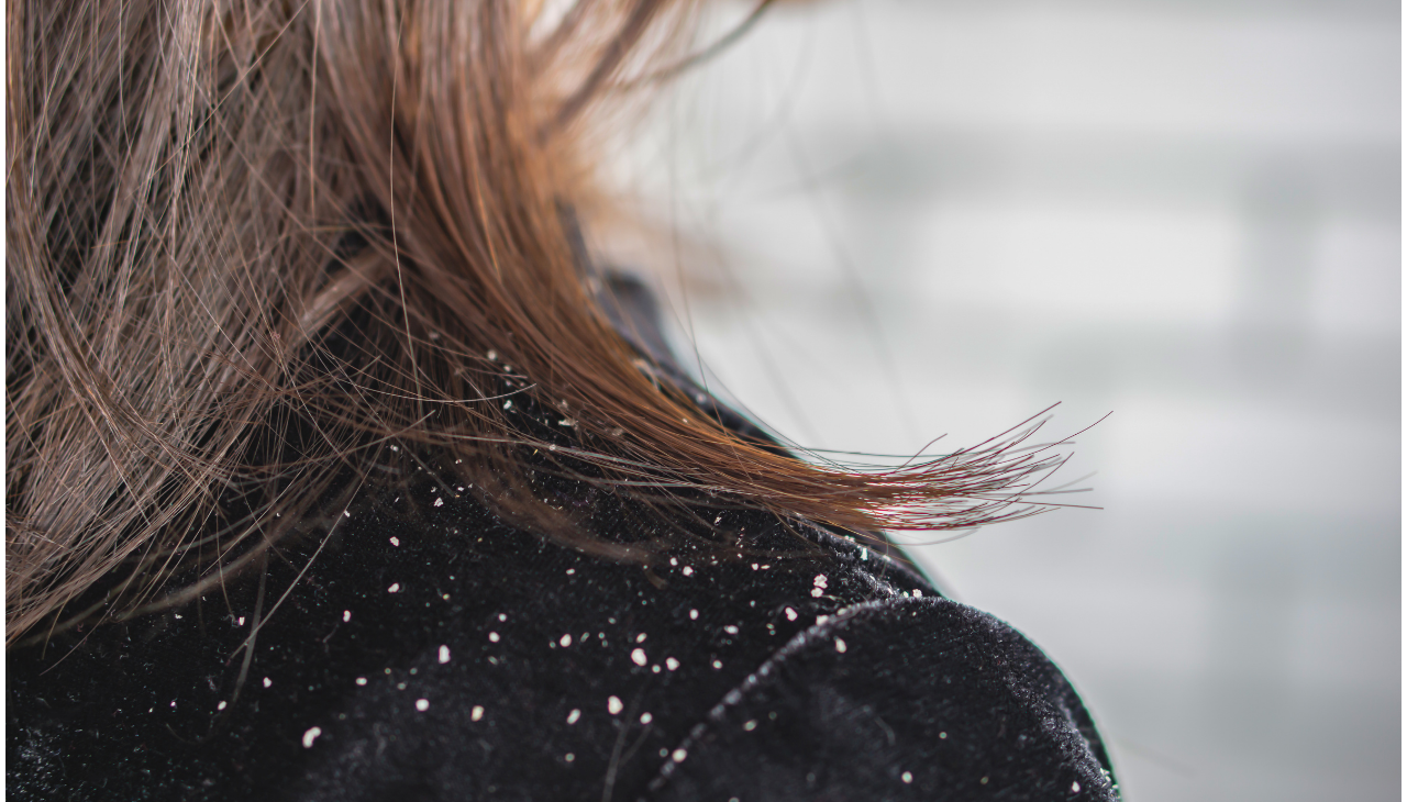 What Is Dandruff?