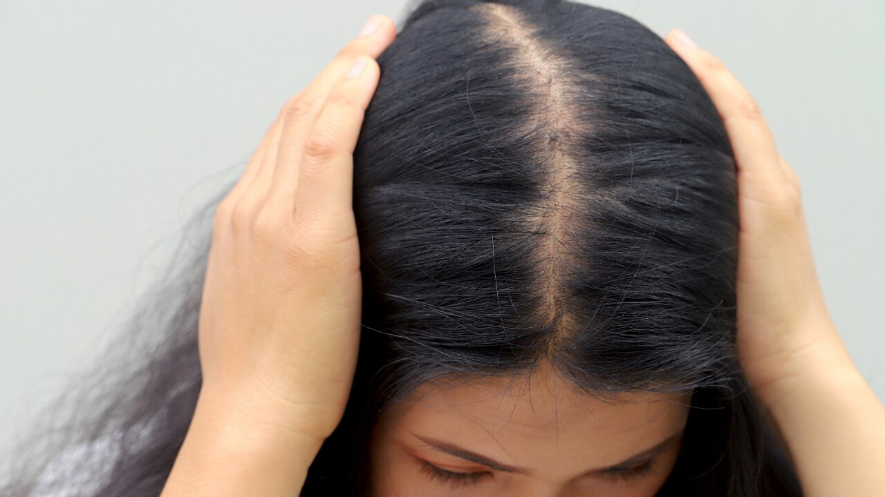 Signs and Symptoms of Hair Loss