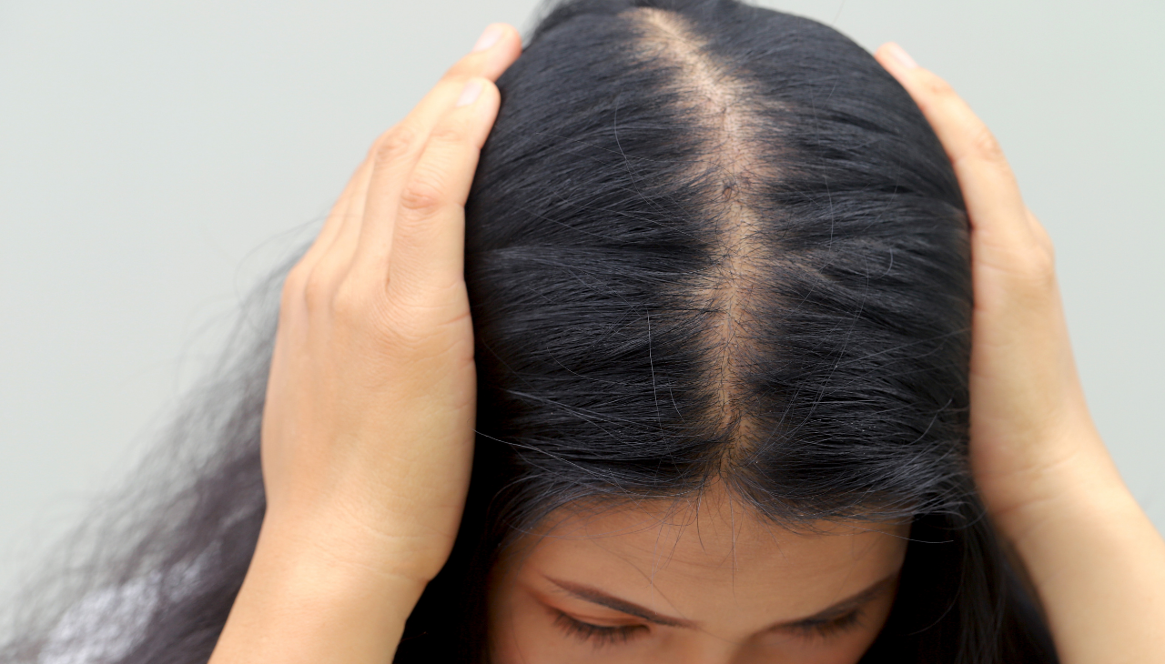 Signs and Symptoms of Hair Loss