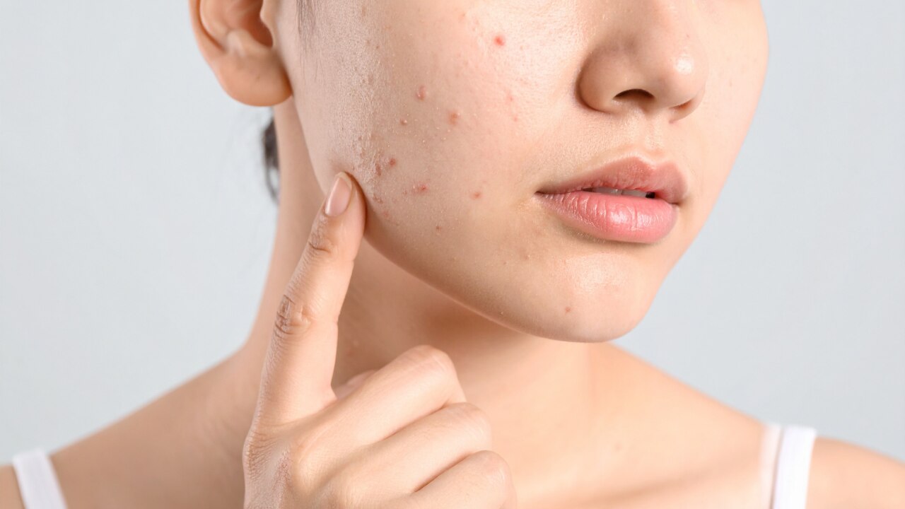 Fights Blemishes: