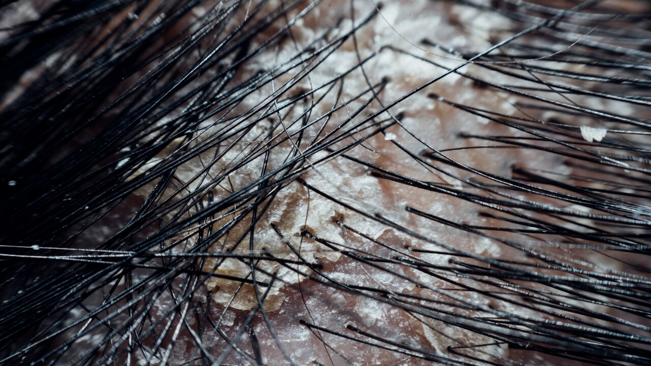 9. Fights Scalp Infections:
